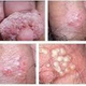 Illustration for article titled obat herpes di kemaluan